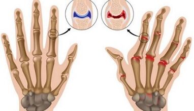 Die Hauptunterschiede von Arthritis und Arthrose