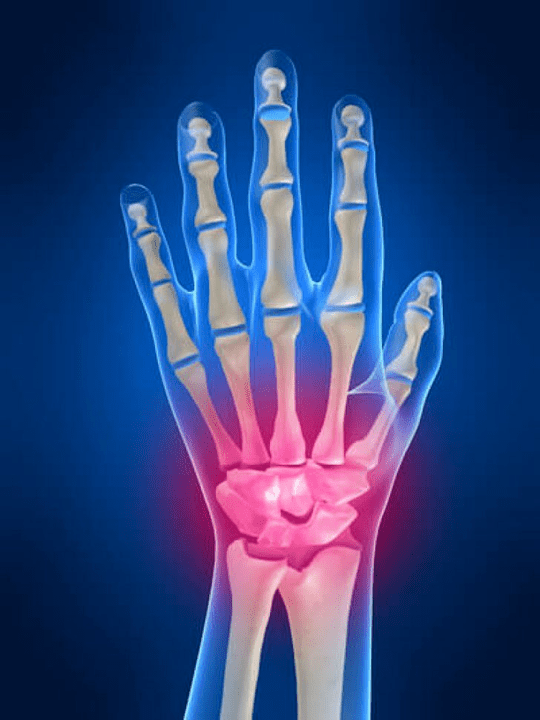 Arthritis des Handgelenksgelenks