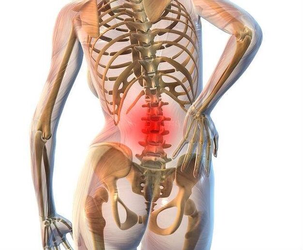 Osteochondrose der Lendenwirbelsäule