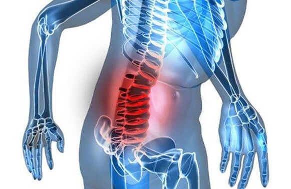 Wirbelsäulendeformität im vierten Stadium der lumbalen Osteochondrose