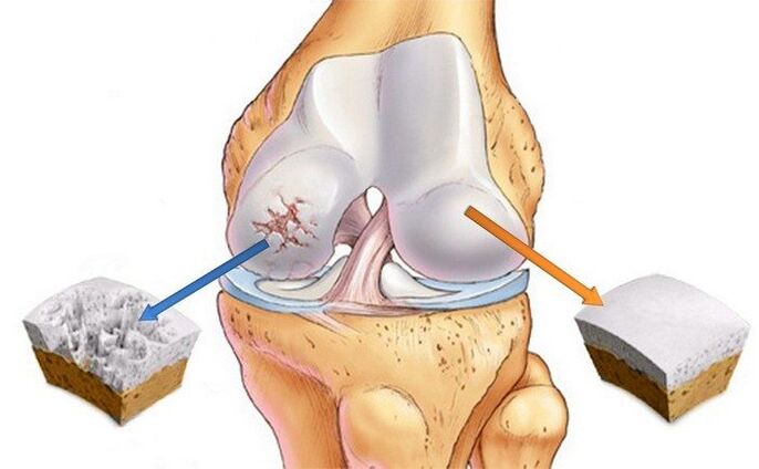 Gesunde und arthrotische Gelenke