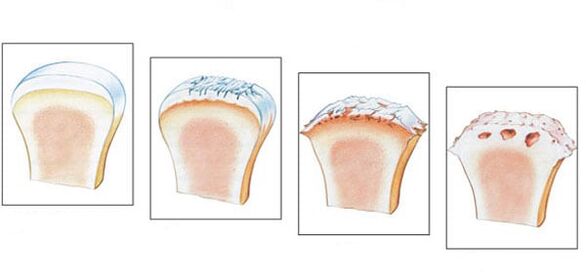 Gesundes Gelenk und 3 Grad der Arthroseentwicklung